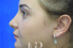 HR Plastic Surgery - Nose Reshaping (Rhinoplasty) patient after 9
