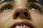 HR Plastic Surgery - Nose Reshaping (Rhinoplasty) patient before 10