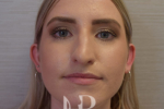 HR Plastic Surgery - Nose Reshaping (Rhinoplasty) patient before 11