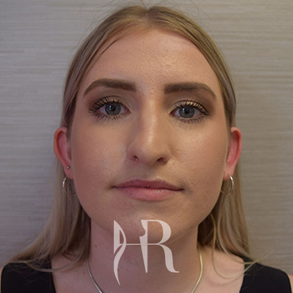 HR Plastic Surgery - Nose Reshaping (Rhinoplasty) patient before 11