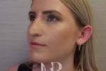 HR Plastic Surgery - Nose Reshaping (Rhinoplasty) patient before 12