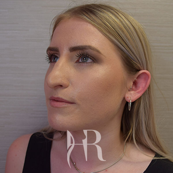 HR Plastic Surgery - Nose Reshaping (Rhinoplasty) patient before 12