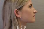 HR Plastic Surgery - Nose Reshaping (Rhinoplasty) patient before 13