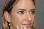 HR Plastic Surgery - Nose Reshaping (Rhinoplasty) patient before 15