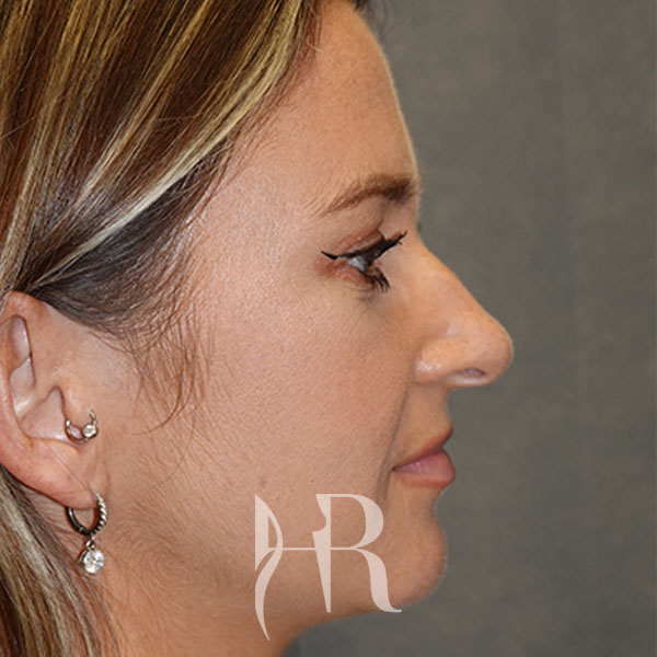 HR Plastic Surgery - Nose Reshaping (Rhinoplasty) patient before 16