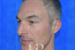 HR Plastic Surgery - Nose Reshaping (Rhinoplasty) patient before 2