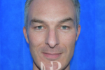 HR Plastic Surgery - Nose Reshaping (Rhinoplasty) patient before 3