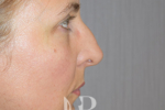HR Plastic Surgery - Nose Reshaping (Rhinoplasty) patient before 4