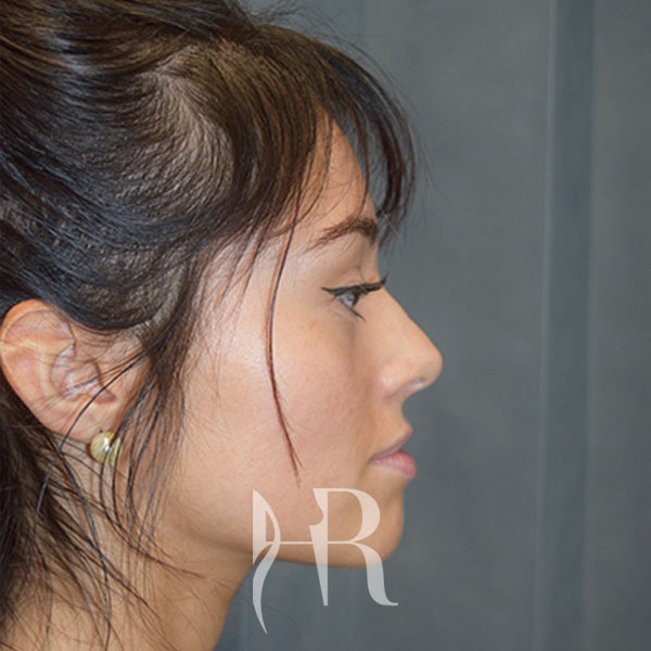 HR Plastic Surgery - Nose Reshaping (Rhinoplasty) patient before 6