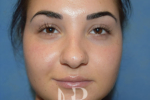 HR Plastic Surgery - Nose Reshaping (Rhinoplasty) patient before 7