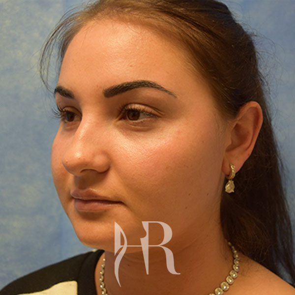 HR Plastic Surgery - Nose Reshaping (Rhinoplasty) patient before 8