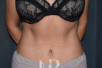 after Tummy Tuck patient 1