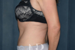 HR Plastic Surgery - Tummy Tuck patient after 2