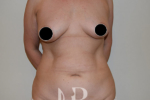 before Tummy Tuck patient 1