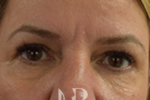 HR Plastic Surgery - Eyelid Surgery (Blepharoplasty) patient after 2