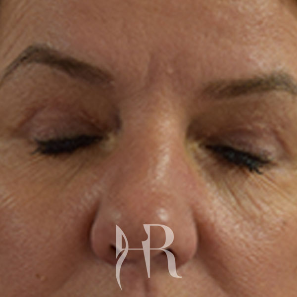 HR Plastic Surgery - Eyelid Surgery (Blepharoplasty) patient after 3