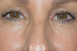 HR Plastic Surgery - Eyelid Surgery (Blepharoplasty) patient after 4