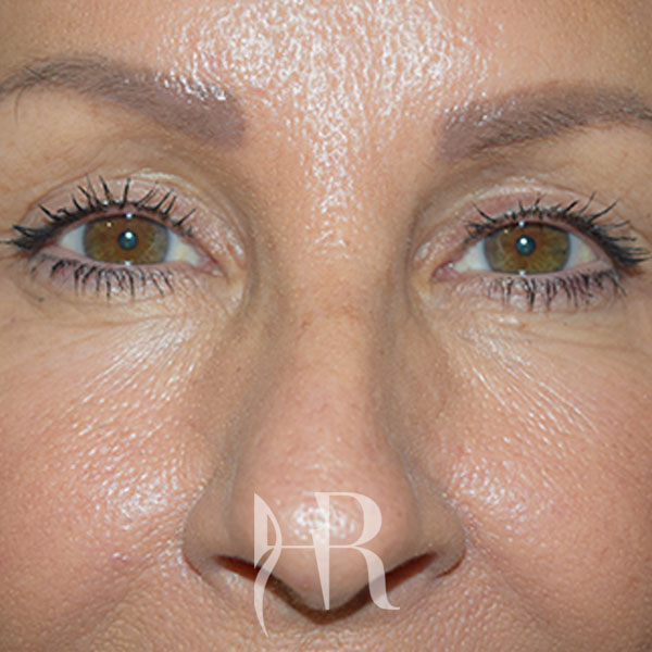 HR Plastic Surgery - Eyelid Surgery (Blepharoplasty) patient after 4