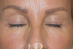 HR Plastic Surgery - Eyelid Surgery (Blepharoplasty) patient after 5