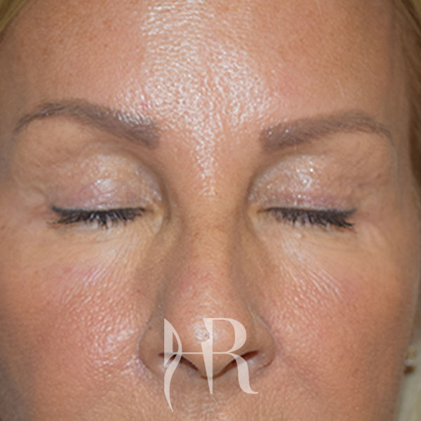 HR Plastic Surgery - Eyelid Surgery (Blepharoplasty) patient after 5