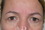 HR Plastic Surgery - Eyelid Surgery (Blepharoplasty) patient before 2