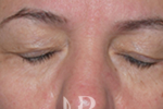 HR Plastic Surgery - Eyelid Surgery (Blepharoplasty) patient before 3