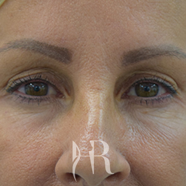 HR Plastic Surgery - Eyelid Surgery (Blepharoplasty) patient before 4
