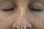 HR Plastic Surgery - Eyelid Surgery (Blepharoplasty) patient before 5