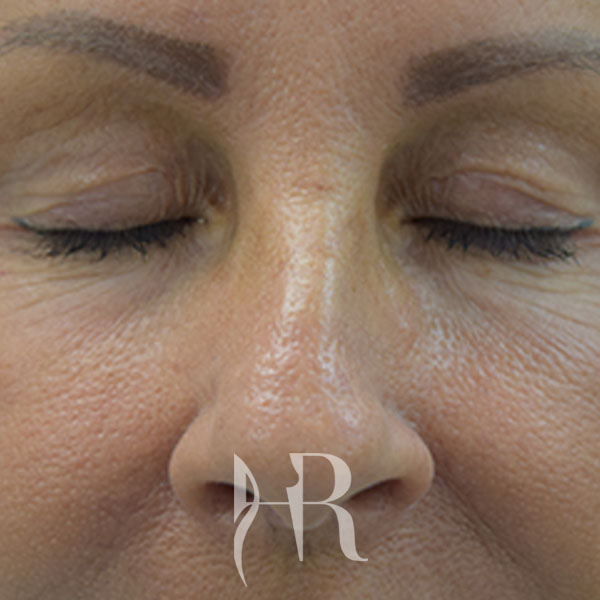 HR Plastic Surgery - Eyelid Surgery (Blepharoplasty) patient before 5