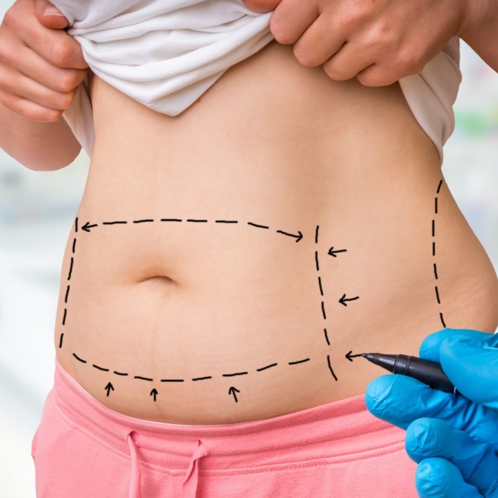pricing tummy tucks